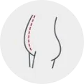 Abdominoplastia