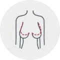 Mamoplastia